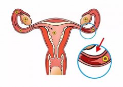 输卵管积水致不孕，试管婴儿成功助孕